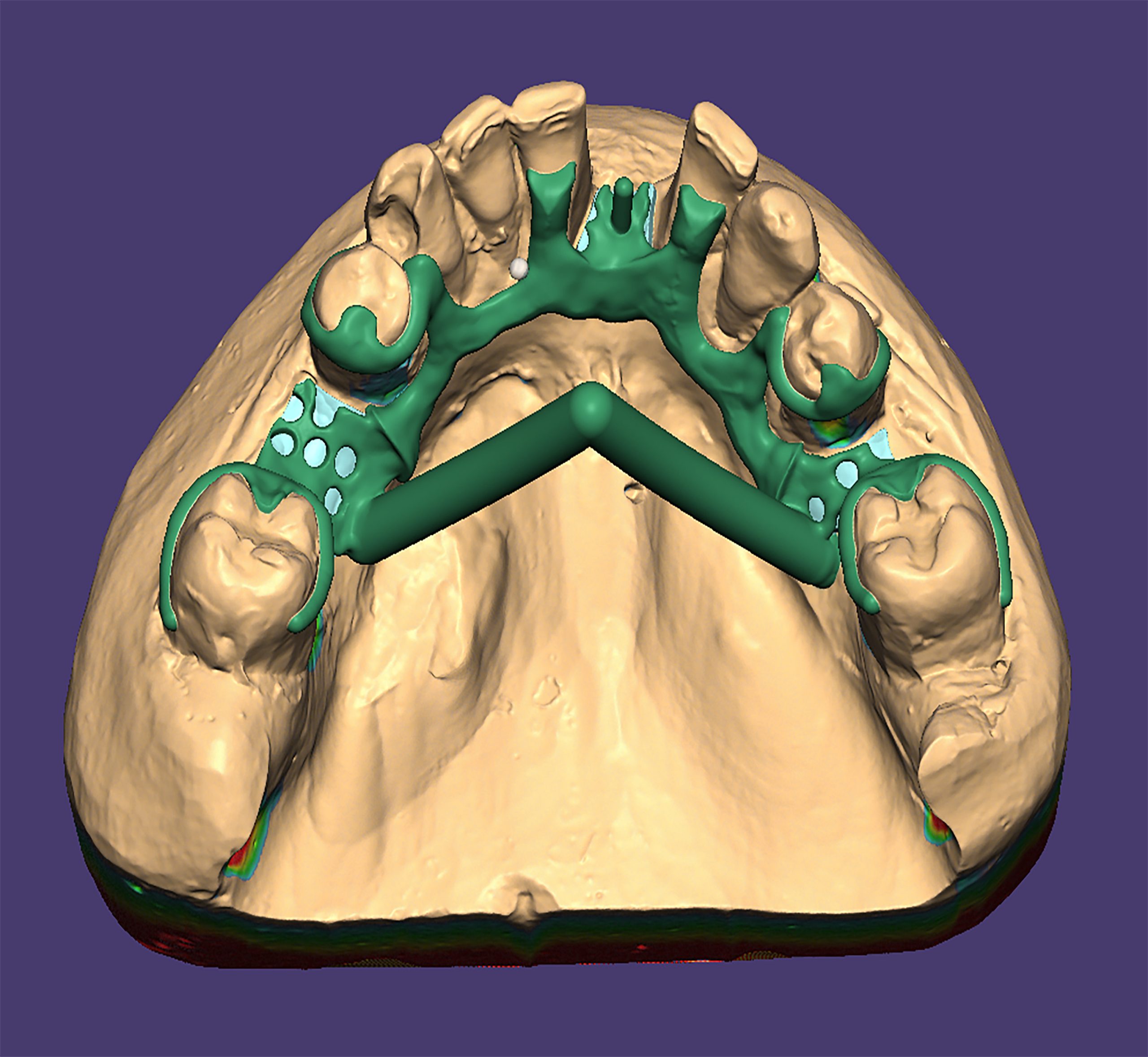 Scheletrato inferiore progettato su EXOCAD CADCAM