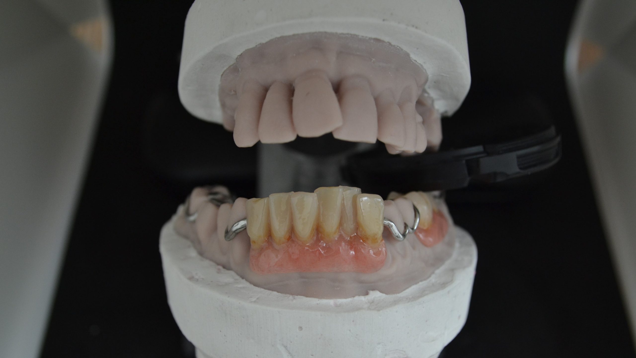 Protesi scheletrata superiore su modelli stampati in 3D